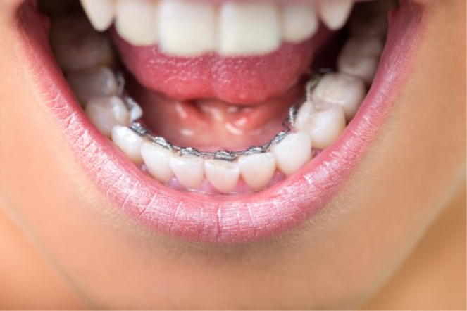 Diş Teli Bakım Süreçleri Nasıl İlerler?