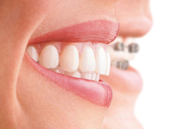 Diş Teli Dişleri Düzeltir Mi?