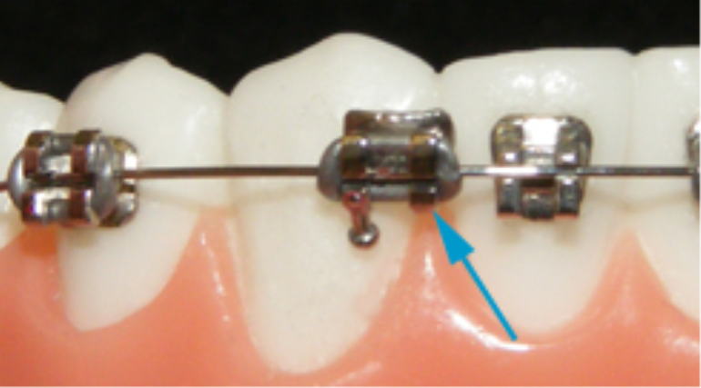 ortodonti tedavisinde dikkat 