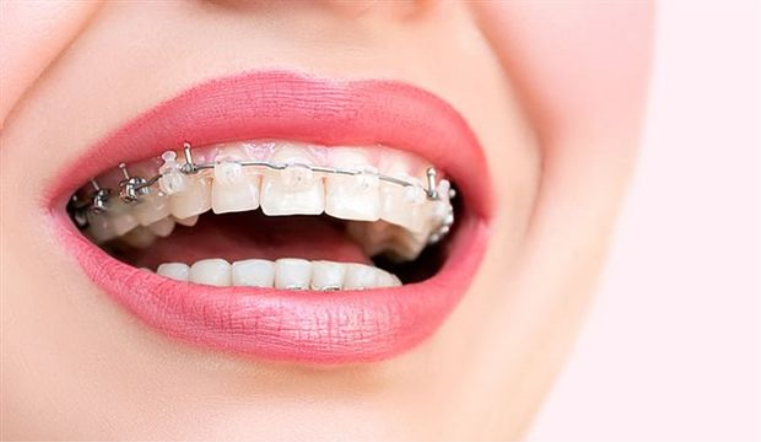 Şeffaf Diş Teli ve Tedavi Sürecine Etkileri