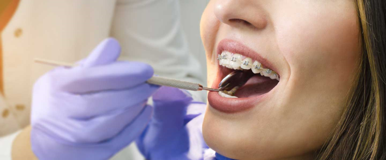 Diş Teli Tedavisinde Braketler 