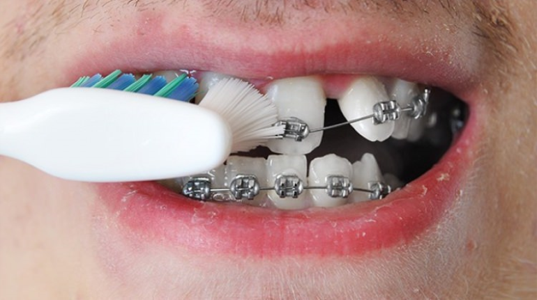 Diş Teli Tedavisinde Dikkat Edilmesi Gerekenler