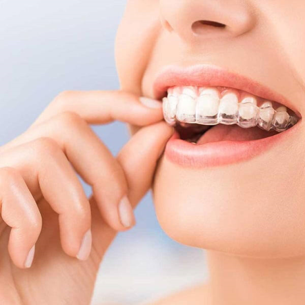 Alpdent ile Diş Teli Tedavisi