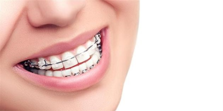 Ortodonti Tedavisinde Dikkat Edilecekler