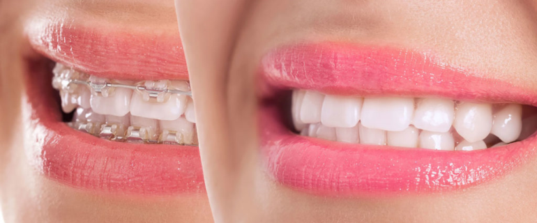 Yetişkinler Ne Kadar Süre Diş Teli Kullanmalı?