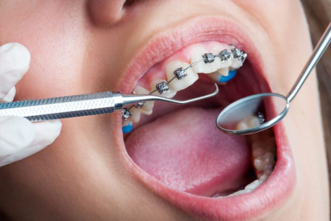 Diş Teli Diş Rengimi Değiştirir Mi?