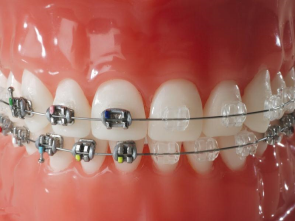 Diş Teli Tedavisine Başvurmalı Mıyım?