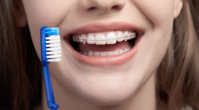 Diş Teli Tedavisi Tüm Detayları