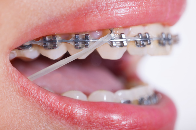 Diş Teli Tedavisini Sürdürme 