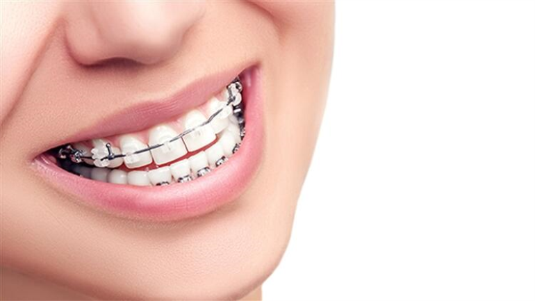 Diş Sağlığında Diş Teli Tedavisi