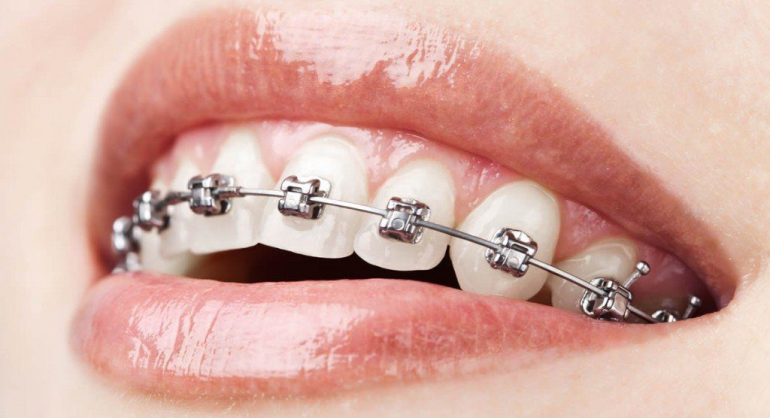 Diş Teli İle Ne Yenmez?