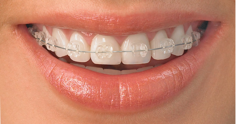 Diş Teli Tedavisinde 2023 Uygulamaları