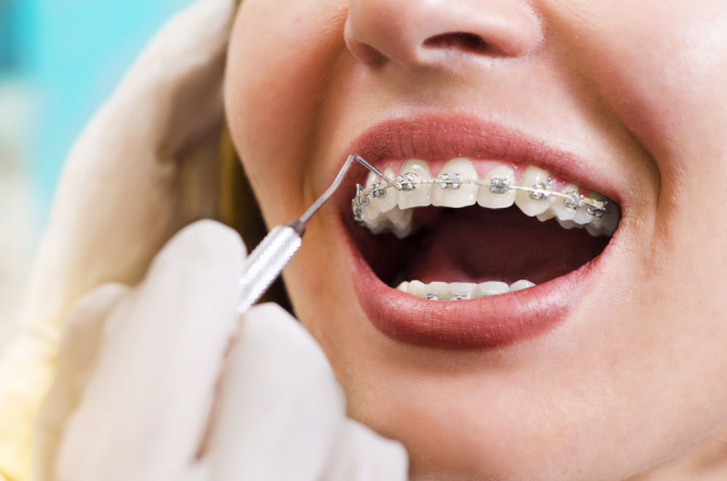 Çocuklarda Diş Teli Tedavisi