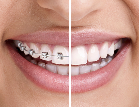Üst Dişlere Diş Teli Uygulaması Nasıl Yapılır?