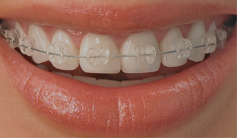 Diş Teli Tedavisinde Rutin Kontrollerin Önemi