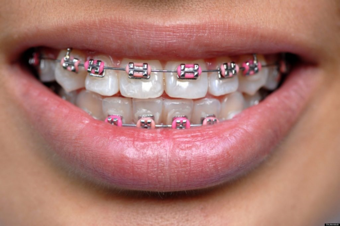 Ortodonti Sürecinde Diş Bakımı Nasıl Olmalıdır?