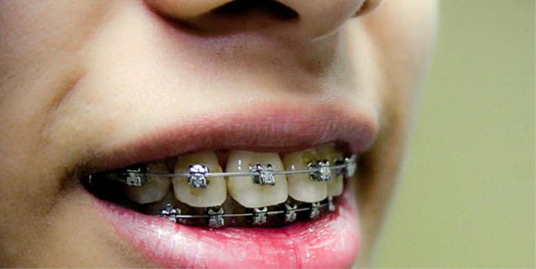 Diş Teli Ne Kadar Süre Kalır?