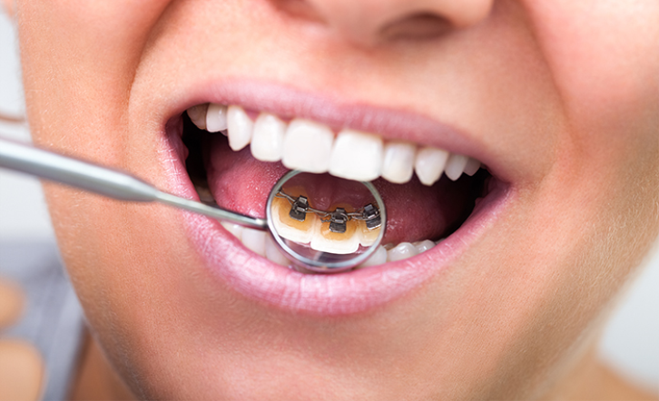 Diş Teli Ne Kadar Süre Takılı Kalır?