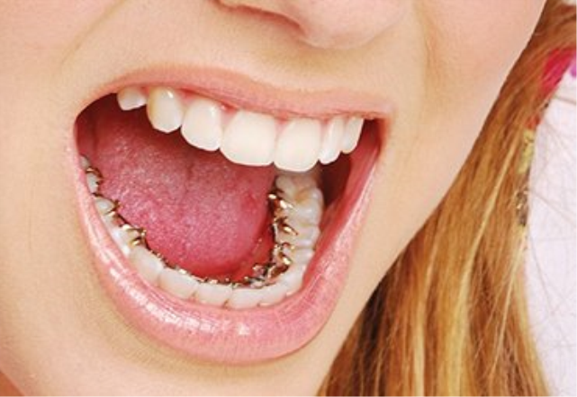 İçten Diş Teli Kullanımı Sağlıklı Mıdır?