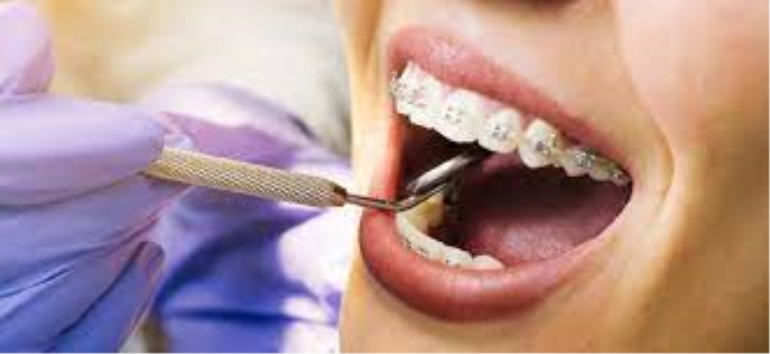 Hangi Klinikte Diş Teli Tedavisi Yaptırılır?