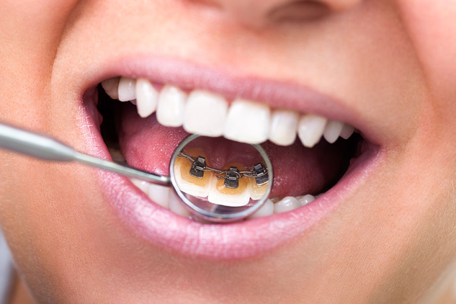 Lingual Ortodonti Nedir?