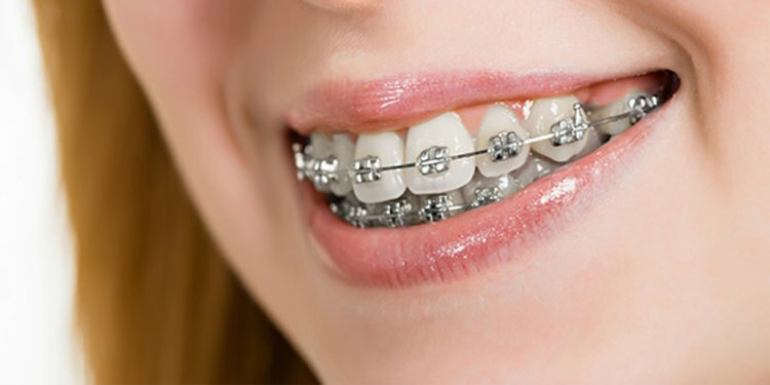 Diş Teli Tedavisi Neden Gereklidir?