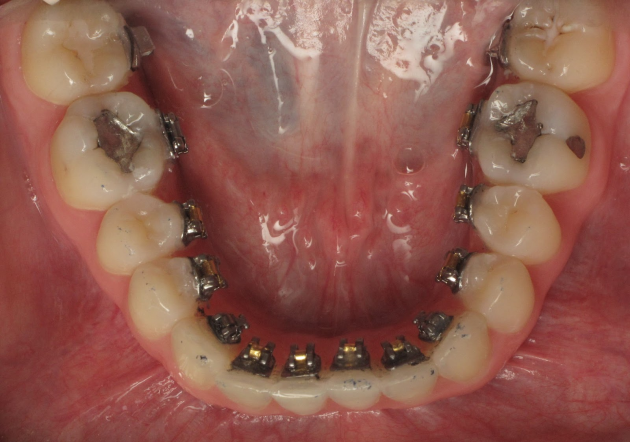 lingual ortodonti