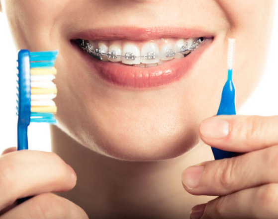 Diş Teli Diş Etine Zarar Verir Mi?