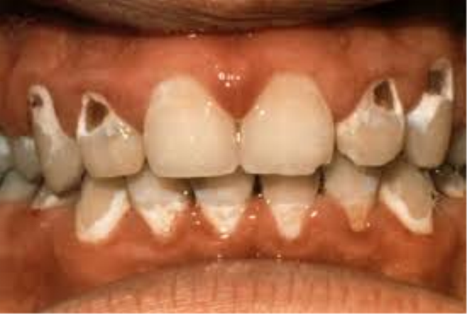ortodonti diş fırçalama