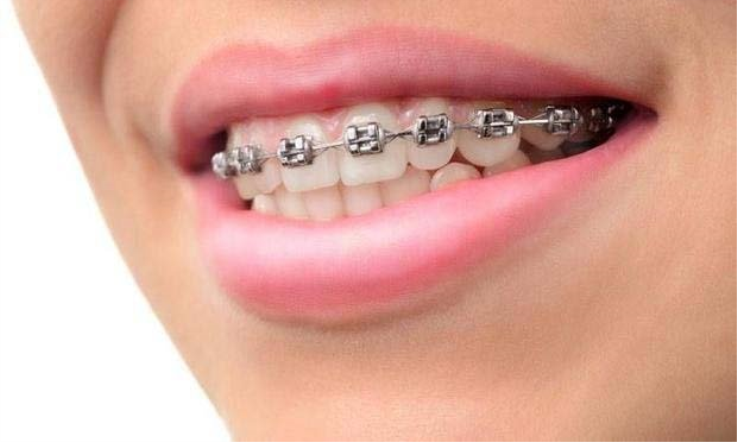 Alt Dişlere Tel Sonra Mı Takılıyor?