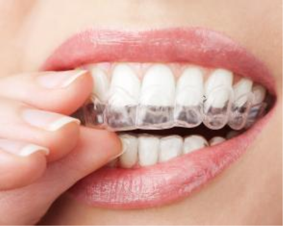 Diş Teli Tedavilerinde Şeffaf Plaklar