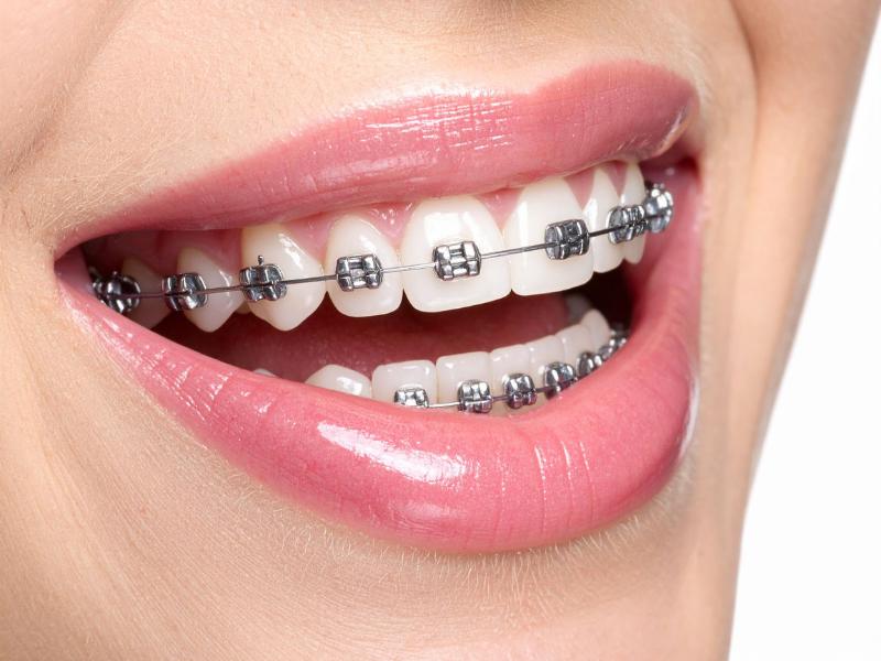 2026’da Diş Teli Fiyatlarının Ne Kadar Artması Bekleniyor?