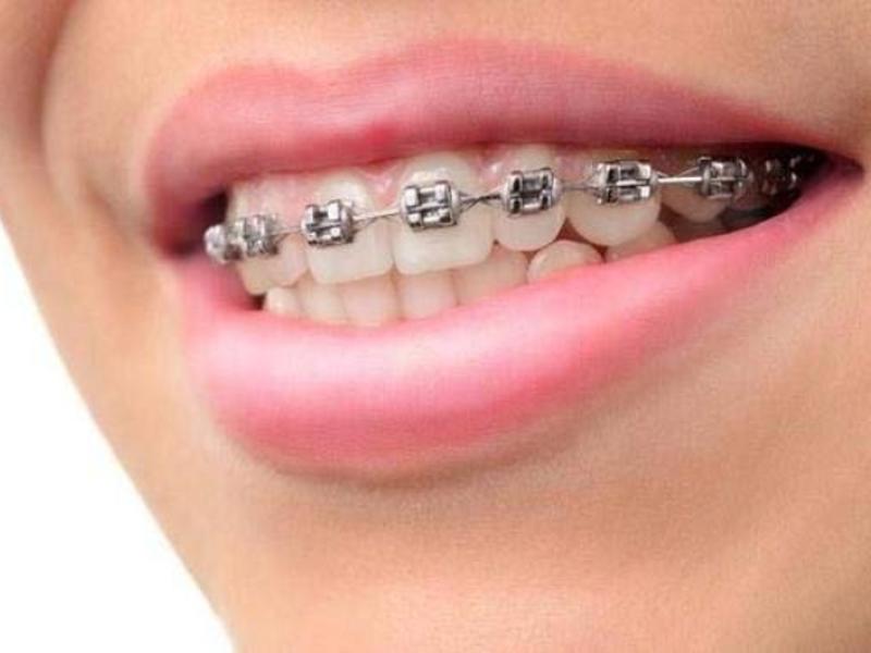 Alt Dişlere Tel Sonra Mı Takılıyor?