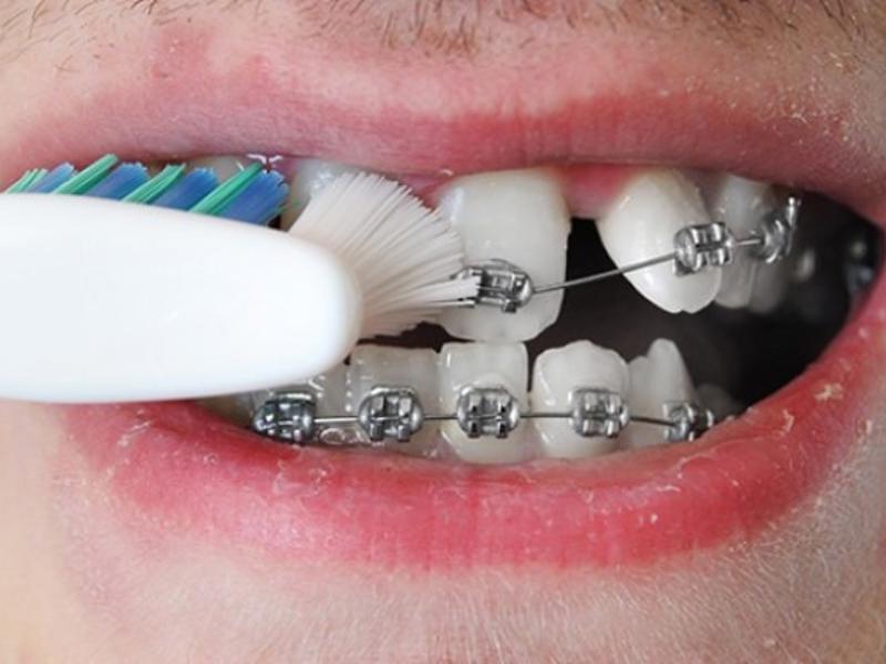 Braketlerimi Nasıl Temizlerim