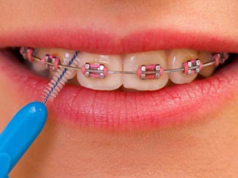 Diş Teli Acıtıyor Mu?