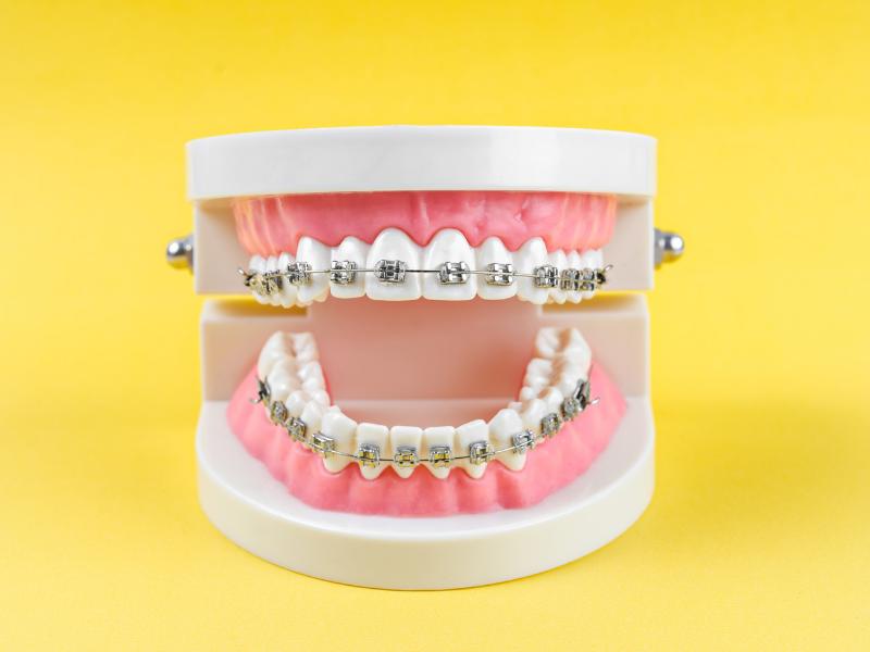 Diş Teli Ağız Kokusu Yapar mı? Nedenleri ve Önlemleri