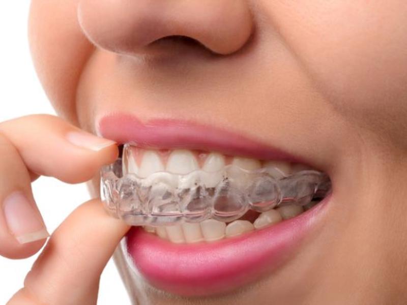 Diş Teli Fiyatları ve Diş Plakları