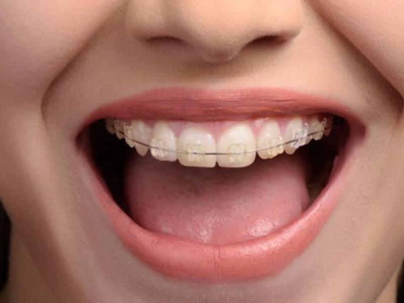 Diş Teli Fiyatları ve Tedavi Süreci