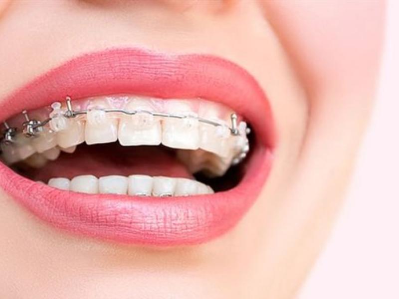 Diş Teli Hakkında Bilgilendirme