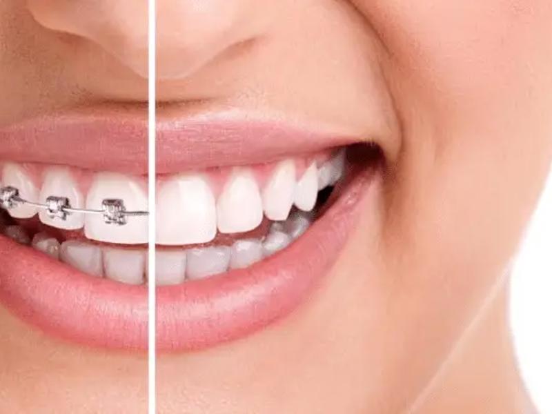 Diş Teli Kullanırken Dikkat Edilmesi Gereken Besinler