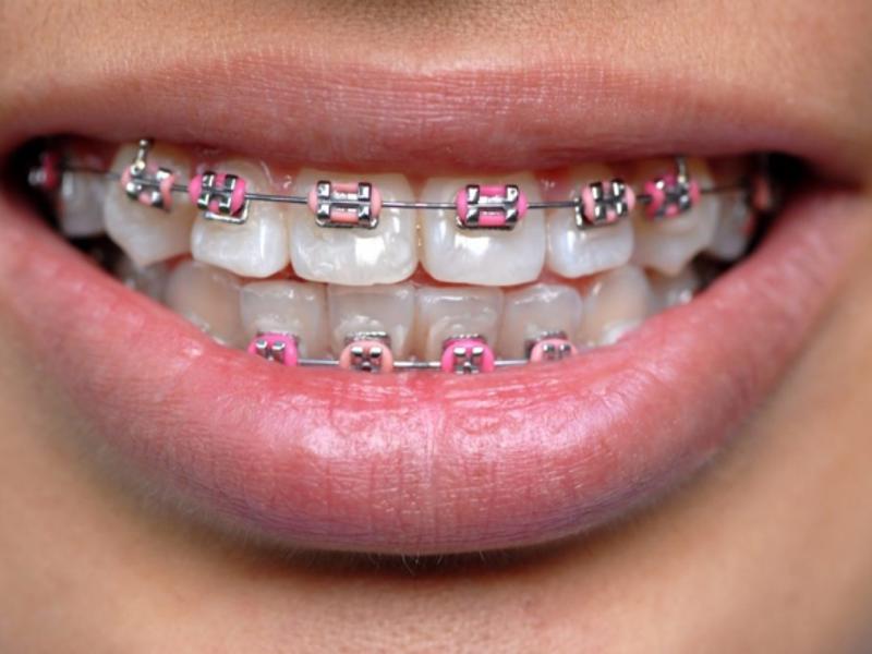 Diş Teli Nasıl Takılır