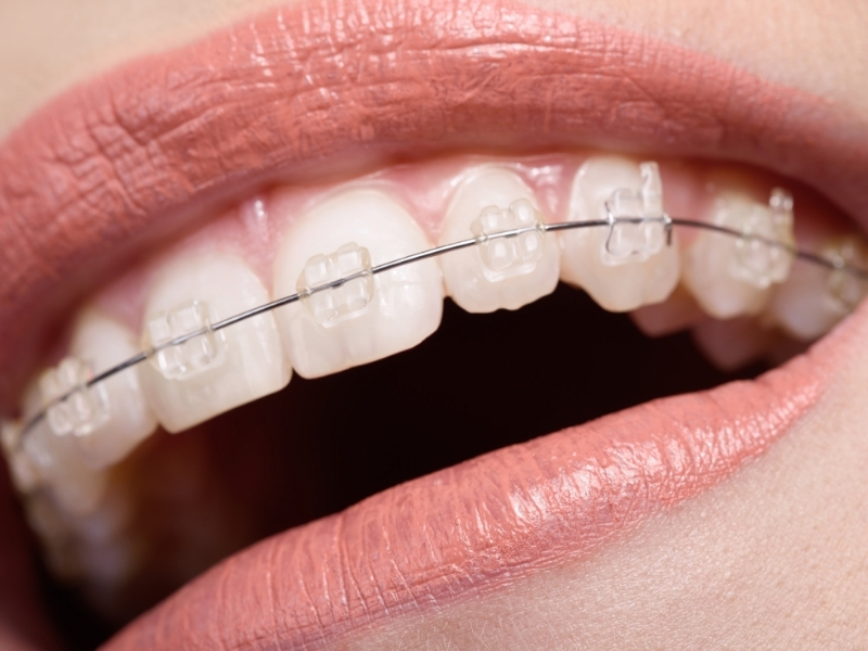 Diş Teli Nasıl Takılır?