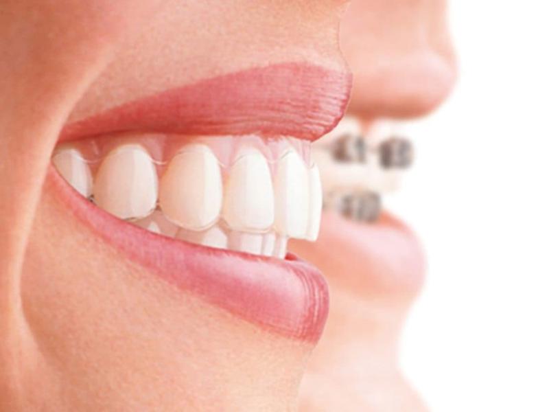 Diş Teli Paslanır Mı?