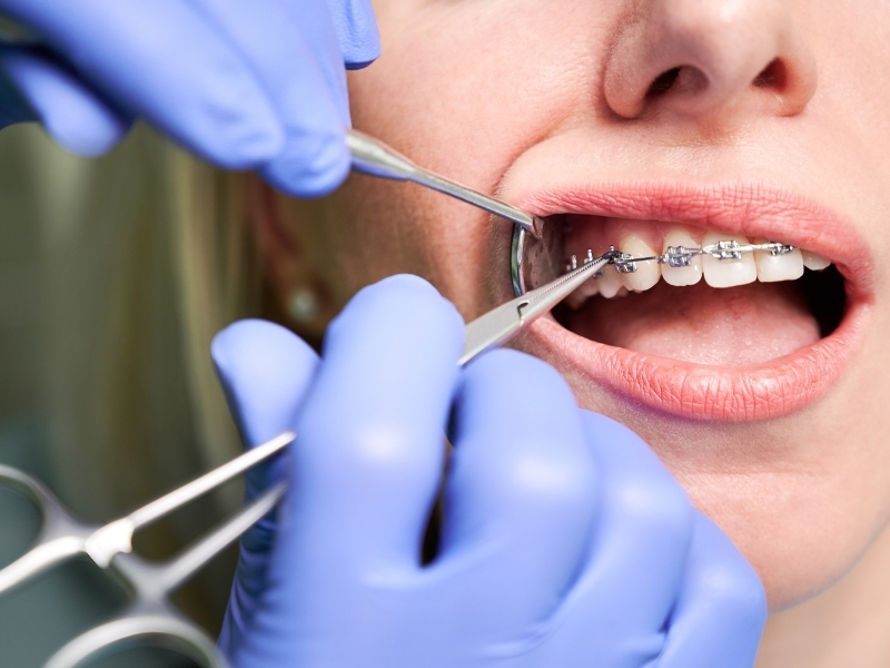 Diş Teli Takılırken ve Sonrasında Acı Hisseder Miyim?