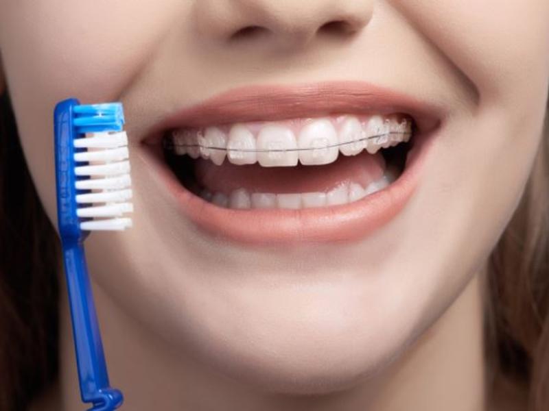 Diş Teli Tedavi Süreçleri