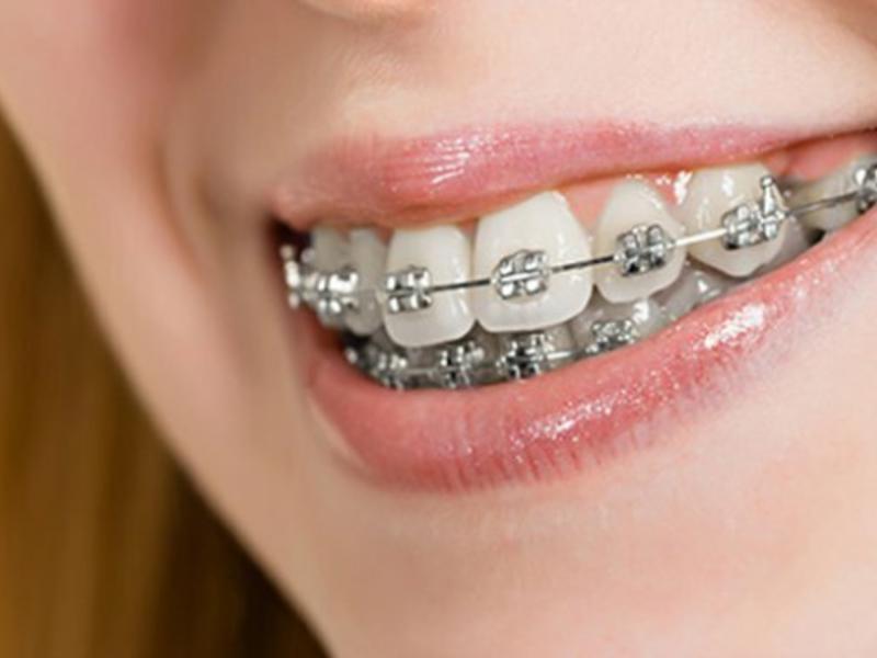 Diş Teli Tedavisinde 2025 Fiyatlar