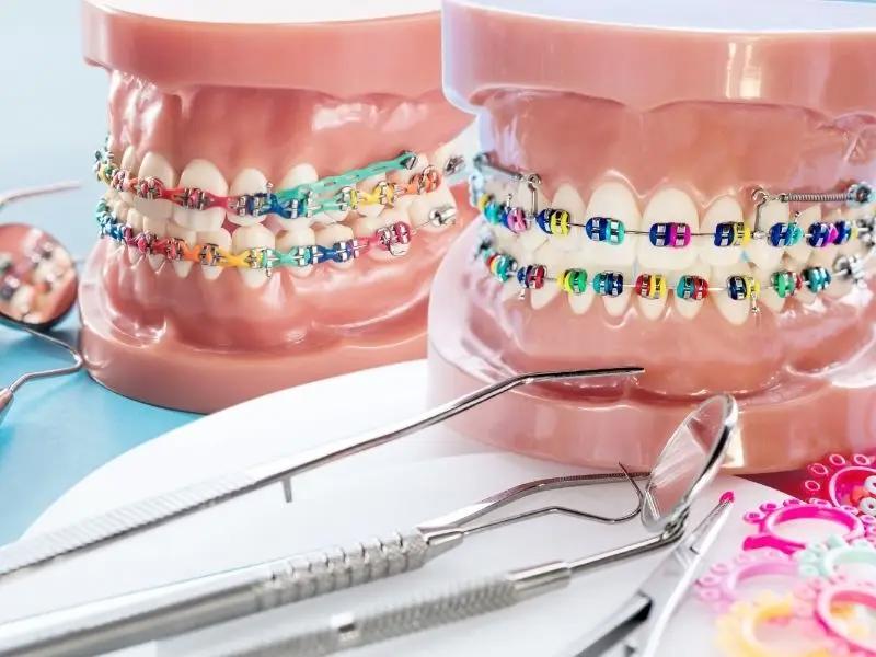 Diş Teli Tedavisinde Kullanılan Ortodontik Elastiklerin Amacı Nedir?