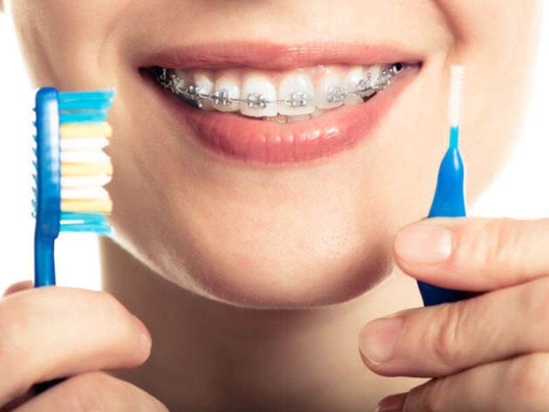 Diş Telleri Sonrasında İz Yapar Mı?