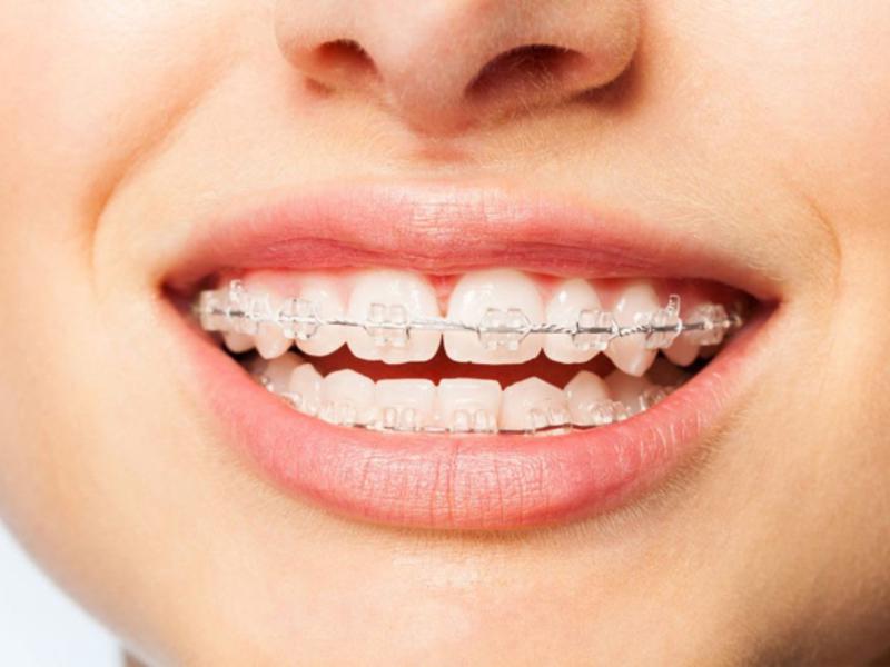 Erişkinlerde Tel Tedavisi