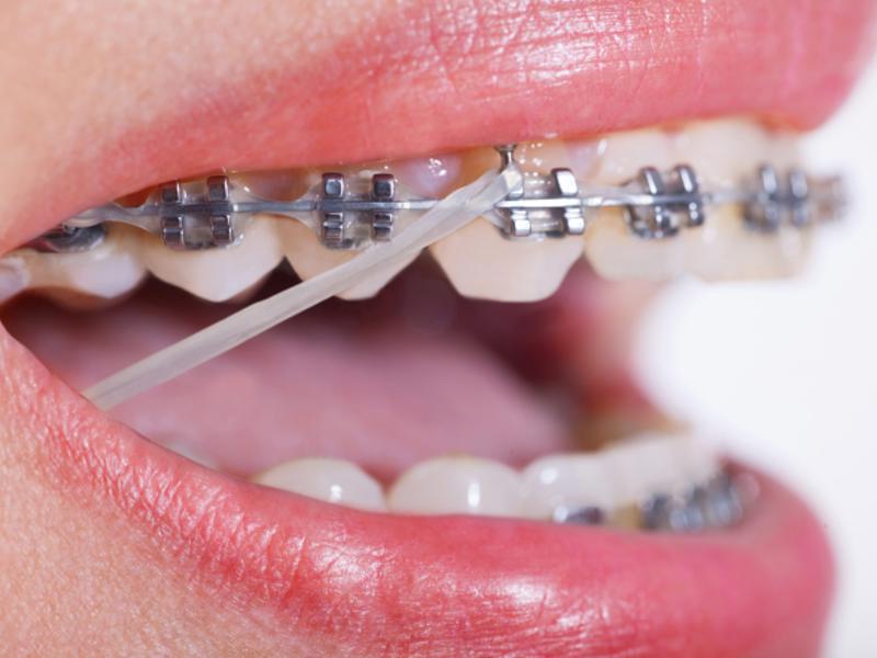 Her Diş Teli Tedavisinde Lastik Kullanılır Mı?